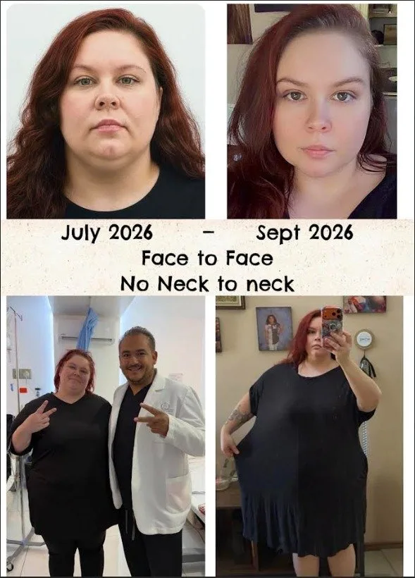 Patient before surgery in July 2026 and two months later in September 2026, including a photo with Dr. Grimaldi and a photo showing her dress now much looser